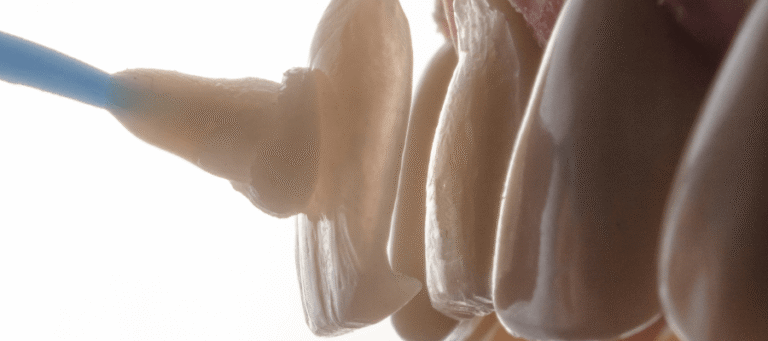 Licowki bez szlifowania licowki addytywne min Licówki bez szlifowania (licówki addytywne)