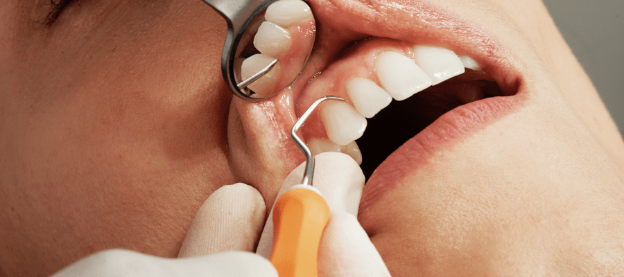 Lakierowanie zębów – co warto wiedzieć