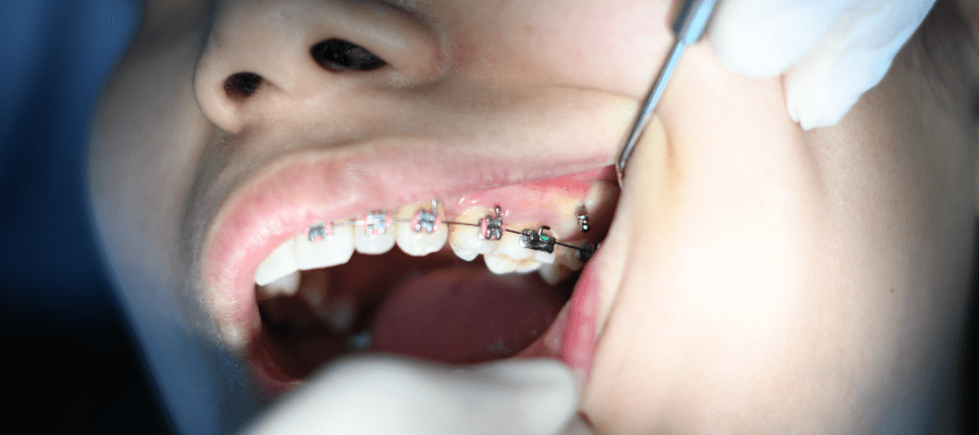Aparat na zębach – kiedy warto go założyć