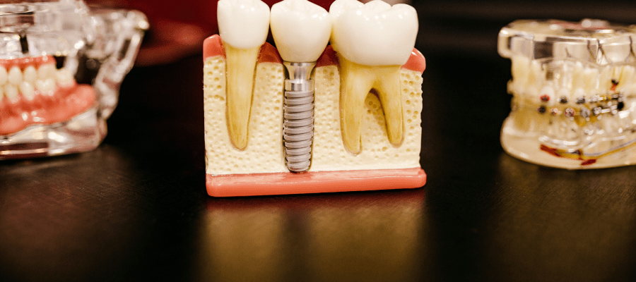 Zastosowanie implantów w przypadku braków zębowych – przegląd opcji
