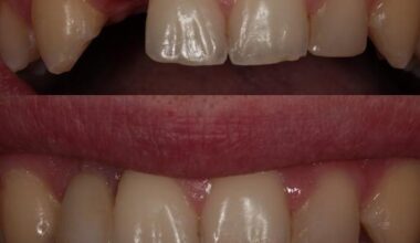 Implantologia – brak jednego zęba (leczenie pourazowe)