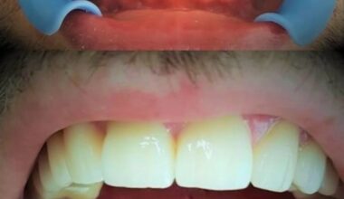 Implanty + korony z podniesieniem zwarcia startych zębów