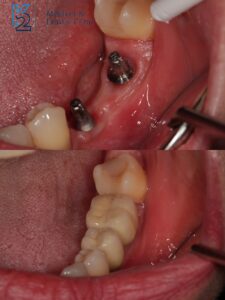 Most porcelanowy na implantach krótkich Bicon – brak trzech sąsiednich zębów