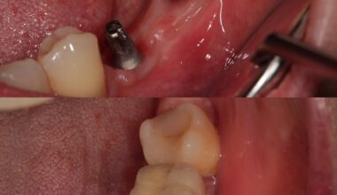 Most porcelanowy na implantach krótkich Bicon – brak trzech sąsiednich zębów