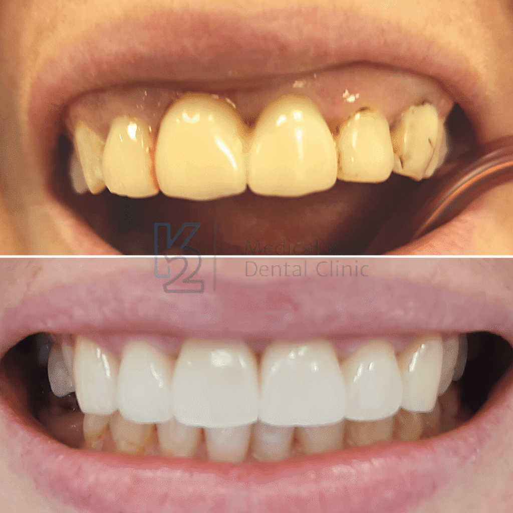 korona na implancie korona cyrkonowa 1 1 korona-na-implancie-korona-cyrkonowa