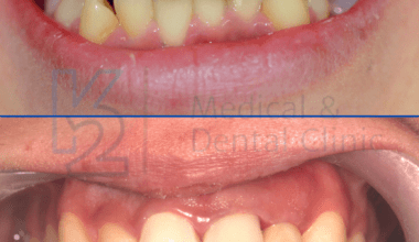Ortodoncja + implanty brakujących zębów