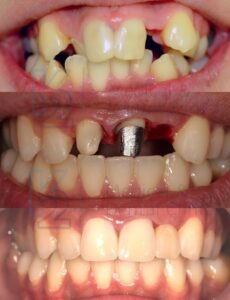 ortodoncja-i-implant