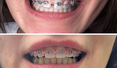 ortodoncja przed i po Mackiewicz