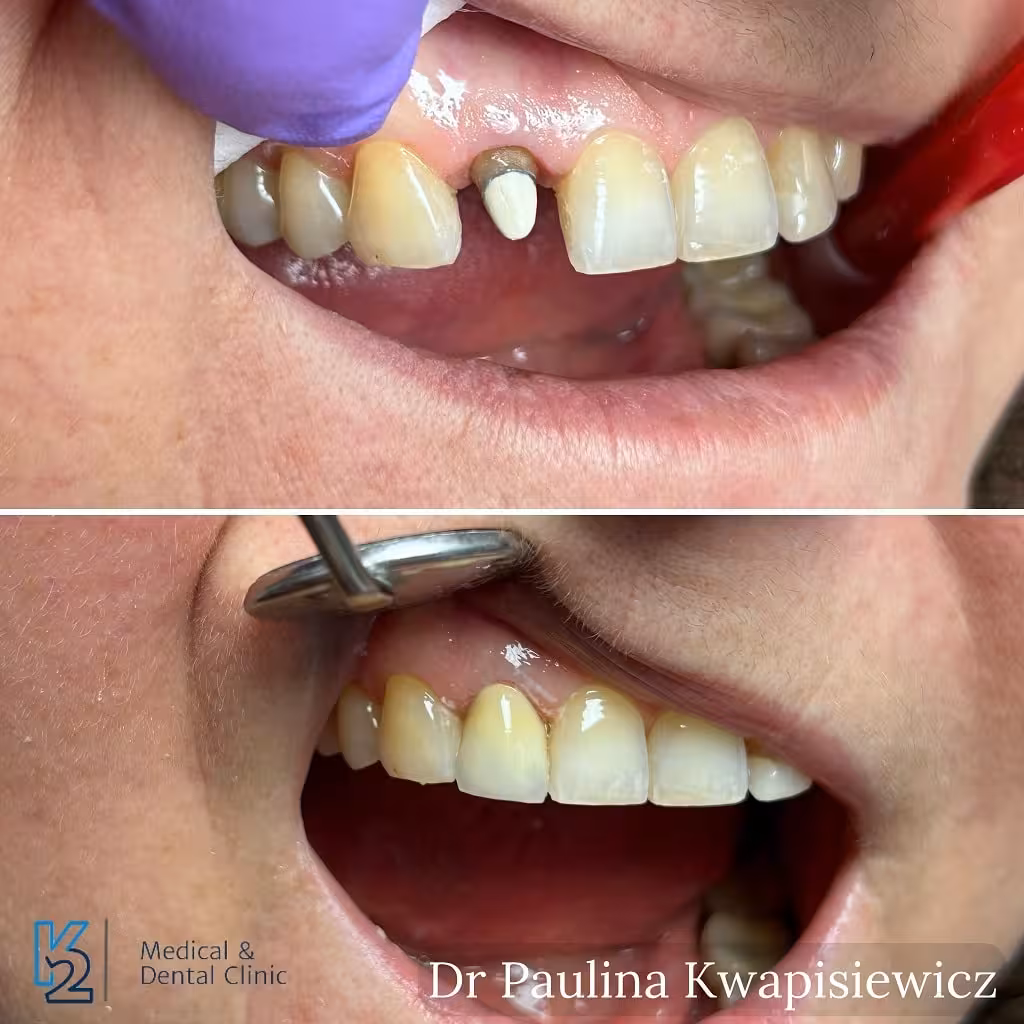 Korona cyrkonowa pełnoceramiczna